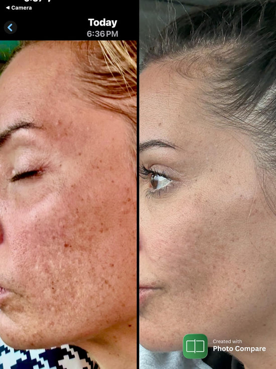 Antes y después usando Azúcar Glow Exfoliator en el rostro